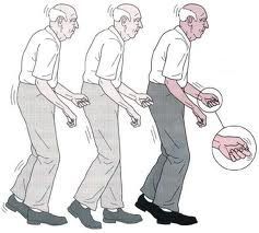 Fisioterapia no Mal de Parkinson