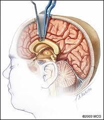 Fisioterapia na Cirurgia de Cabeça