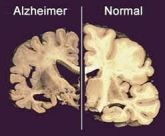 Fisioterapia no Mal de Alzheimer