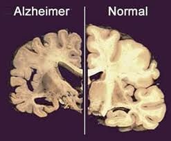 Fisioterapia no Mal de Alzheimer