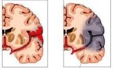 Fisioterapia no AVC Isquêmico ou Hemorrágico